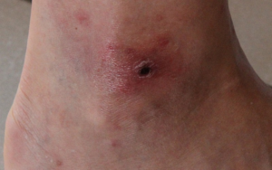 eschar2